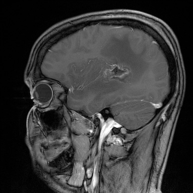 Hirntumor Nach Der Operation Mrt T1 Gewichtet Mit Kontrastmittel Sagital Aus Dem Kgu Kampf Dem Glioblastom