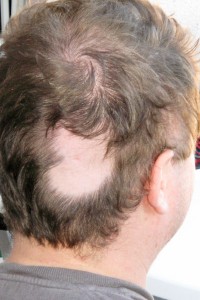 Haarausfall nach der Bestrahlung